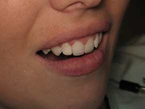 Smile after bonding procedure.