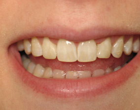 Smile after bonding procedure.