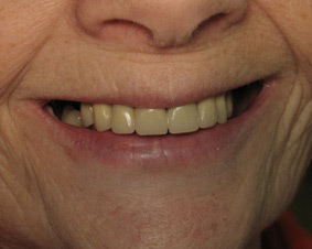 Smile after dental bridge procedure.