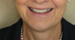 Smile after cosmetic dental procedure