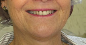 Smile before cosmetic dental procedure