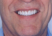 Smile after dental crown procedure.