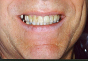 Smile before dental crown procedure
