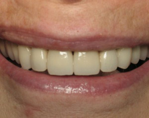 Smile after dental crown procedure.