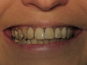 Smile before dental crown procedure.