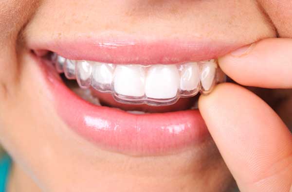 Woman using clear aligner at  Capital Dental Center in Washington, DC.