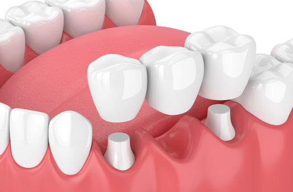 Rendering of jaw with dental bridge.