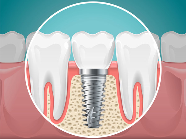 Diagram of a tooth replaced with a dental implant.