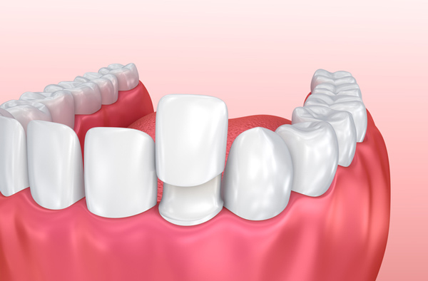 Rendering of jaw with dental veneer on tooth.